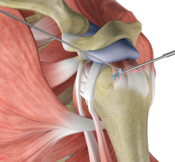 Rotator Cuff Repair Rehab - Adam Watson Orthopaedic Surgeon